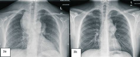 Lymphoma Chest X Ray