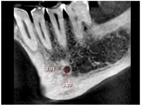 Mandibular Foramen Radiograph