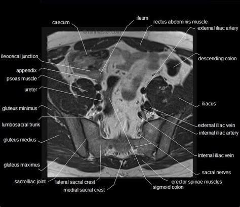 28 best MRI MALE PELVIS images on Pinterest | Pelvis anatomy, Cross stitches and Crosses