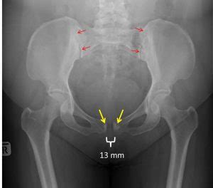 Symphysis pubis diastasis – Radiology Cases