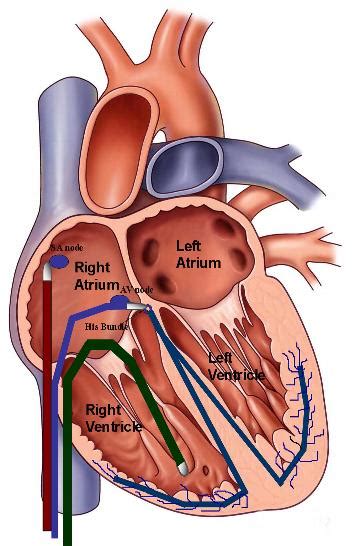 Catheter Ablation for Arrhythmias, Washington DC & Maryland