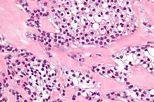 Hyalinizing clear cell carcinoma - Libre Pathology