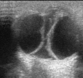 Choroidal Detachment-USG - Sumer's Radiology Blog