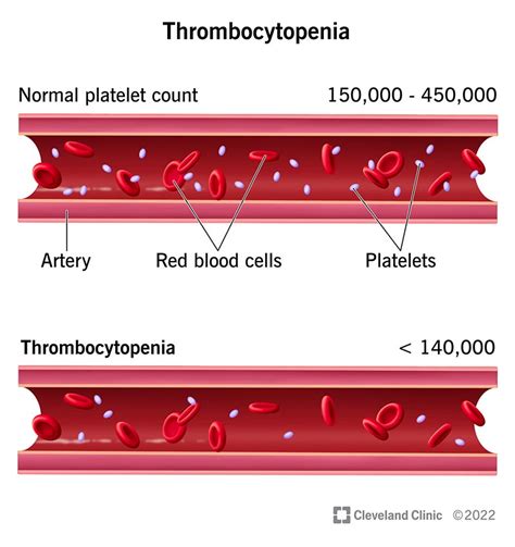 Thrombocytopenia Concept Map Thrombocytopenia Low Pla - vrogue.co