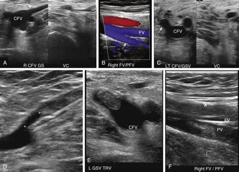 Ultrasound Diagnosis of Lower Extremity Venous Thrombosis | Radiology Key