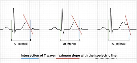 ECG Exam Template • LITFL • ECG Library Basics