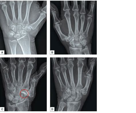 Basal Joint Arthritis Surgery