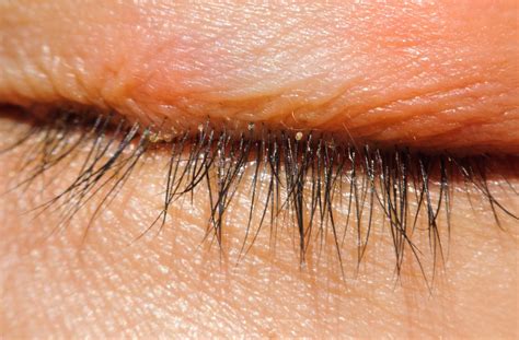 Blepharitis: the Low-Down on Scaly, Itchy Eyelids | MyDryEye