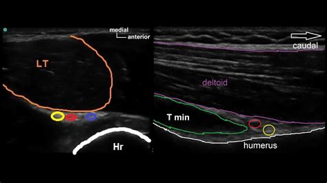 Axillary nerve block: supine and lateral approaches - YouTube