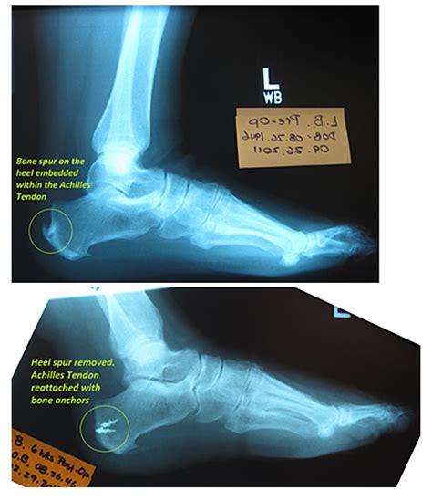 Achilles Tendon Surgery | Dr. Alice Wang