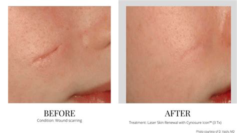 Scar Removal Laser Abu Dhabi at Robert Ferreira blog