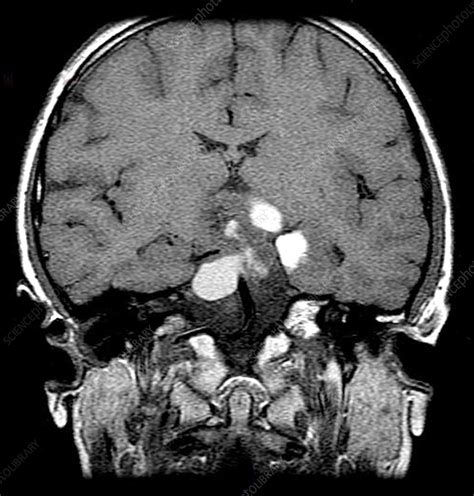 MRI of Craniopharyngioma - Stock Image - C043/5523 - Science Photo Library