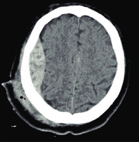 A CT scan of epidural hemorrhage that will be used an example for the... | Download Scientific ...