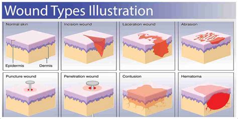 5.1 Lesson: Types of wounds - Siren Training