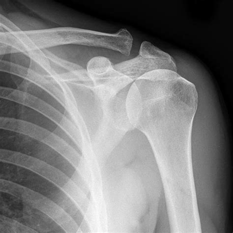 Xray Shoulder Normal