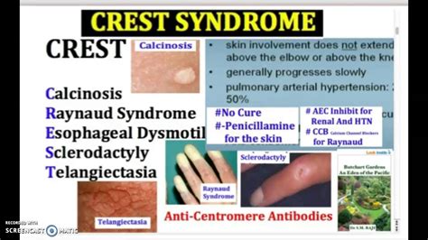 CREST SYNDROME: crest syndrome - causes, symptoms, treatment, usmle, medicine in 3 minutes - YouTube