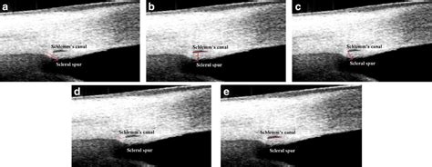 The measurement of scleral spur and Schlemm’s canal parameters. a The ...