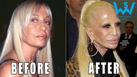 Worst celebrity plastic surgery disasters | Plastic surgery fails | Bad ...