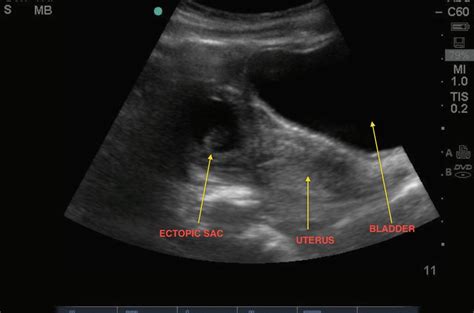 Ruptured Ectopic Pregnancy Ultrasound