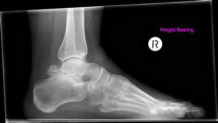 Subtalar Joint - Physiopedia