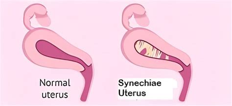 What is Synechiae Uterus and How to Treat It in 2023?