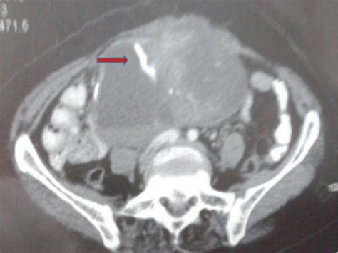 Computed tomography abdomen scan showed well defined approx 12×8×10 cm... | Download Scientific ...