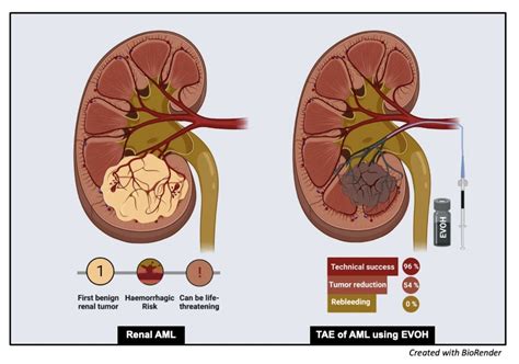 JCM | Free Full-Text | Safety, Efficacy and Mid-Term Outcome for Transarterial Embolization (TAE ...