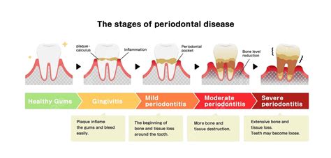 The Stages Of Periodontitis Disease Vector Illustration Human Periodontitis Periodontal Disease ...