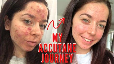 Accutane Before And After Bacne