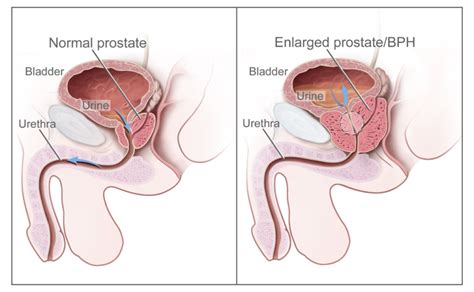 [Figure, Normal prostate and benign prostatic...] - PDQ Cancer Information Summaries - NCBI ...