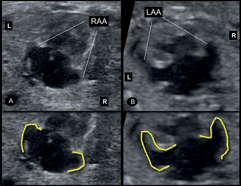 Fetal Heterotaxy and Situs Inversus | Obgyn Key