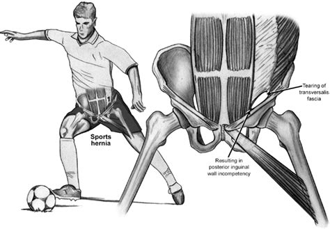 Abdominal Sports Hernia