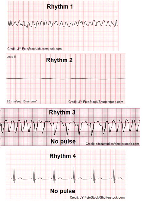 Asystole ECG/EKG Quiz Questions