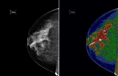 Microcalcifications and Stereotactic Biopsy - Do What You Gotta Do - YouMeMindBody