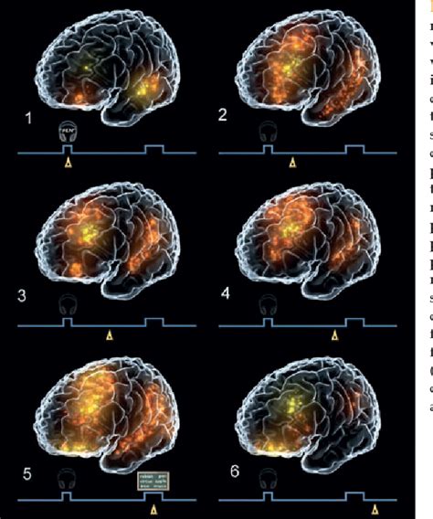 Figure 12.14 from A RECONSTRUCTION OF THE INJURY TO PHINEAS GAGE ...