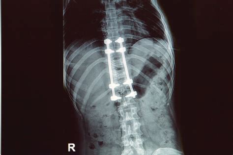 What to do after a Failed Spinal Fusion Surgery? | Dr. Sinicropoi