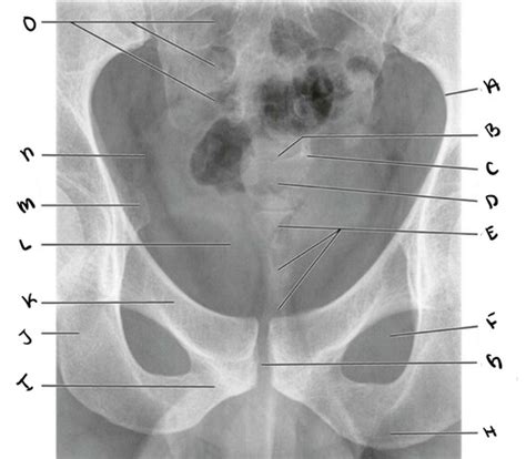 Sacrum ap labeling xray Flashcards | Quizlet