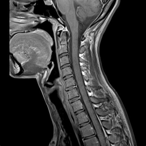 3 Tesla MRI Magnetic Resonance Imaging — North Country Neurology PC