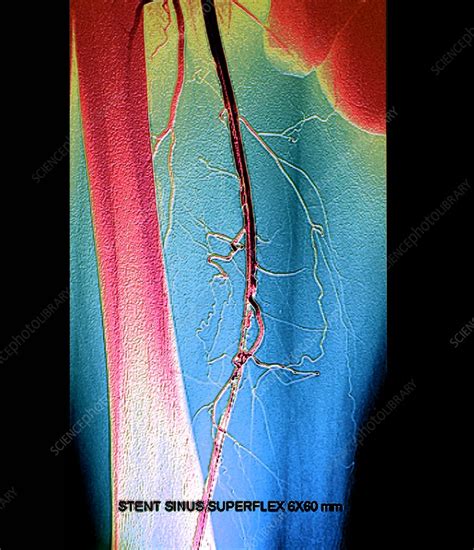 Leg artery angioplasty, angiogram - Stock Image - C048/9311 - Science Photo Library