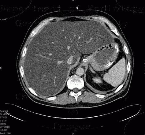 Radiology case: Liver steatosis