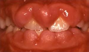 Gingival Hyperplasia | News | Dentagama