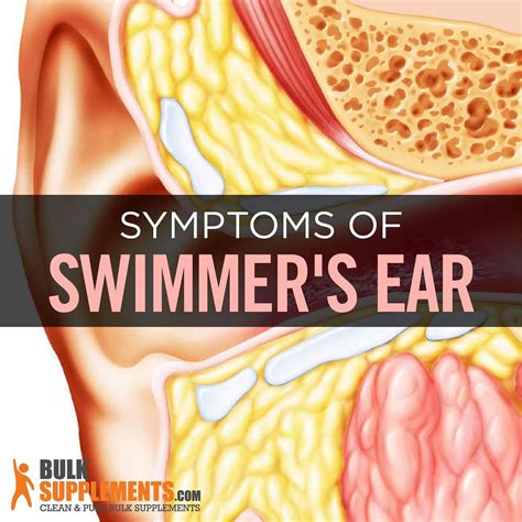 Swimmer’s Ear: Symptoms, Causes & Treatment - James Denlinger - Medium