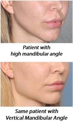 38 Steep/open mandibular plane ideas | korean plastic surgery, steep, chin implant