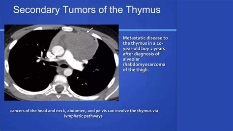 Mediastinum Tumors PPT | PPT