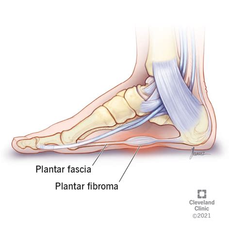 Plantar Fibroma: What It Is, Causes, Symptoms and Treatment