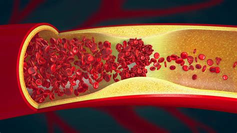 Thrombose artérielle : signes, causes, traitements