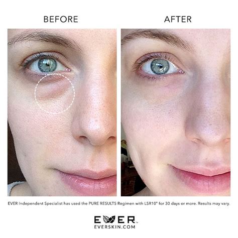 We LOVE seeing these REAL results! | Puffy eyes remedy, Dark spots under eyes, Dark spot remover ...