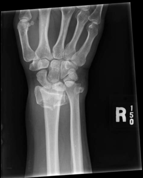 Distal Radius Fractures - Trauma - Orthobullets