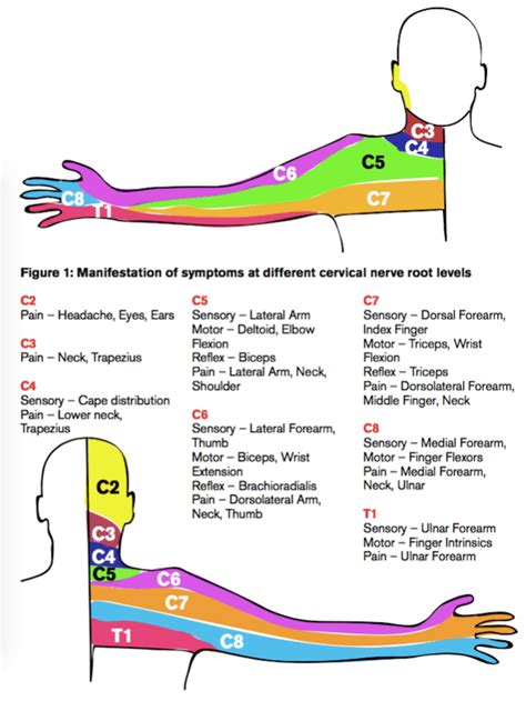 Cervical Radiculopathy | Emergency Physicians Monthly