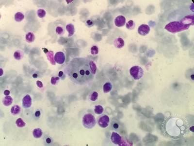 Hemophagocytosis in a Young Woman with a Recent Diagnosis of Adult Onset Still’s Disease